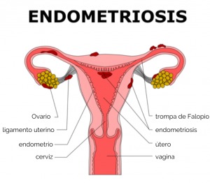 ENDOMETRIOSIS MANEJO INTEGRAL