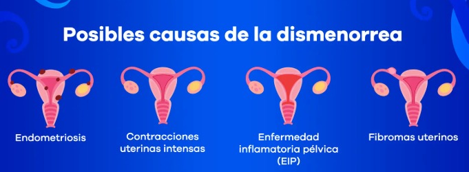 DISMENORREA